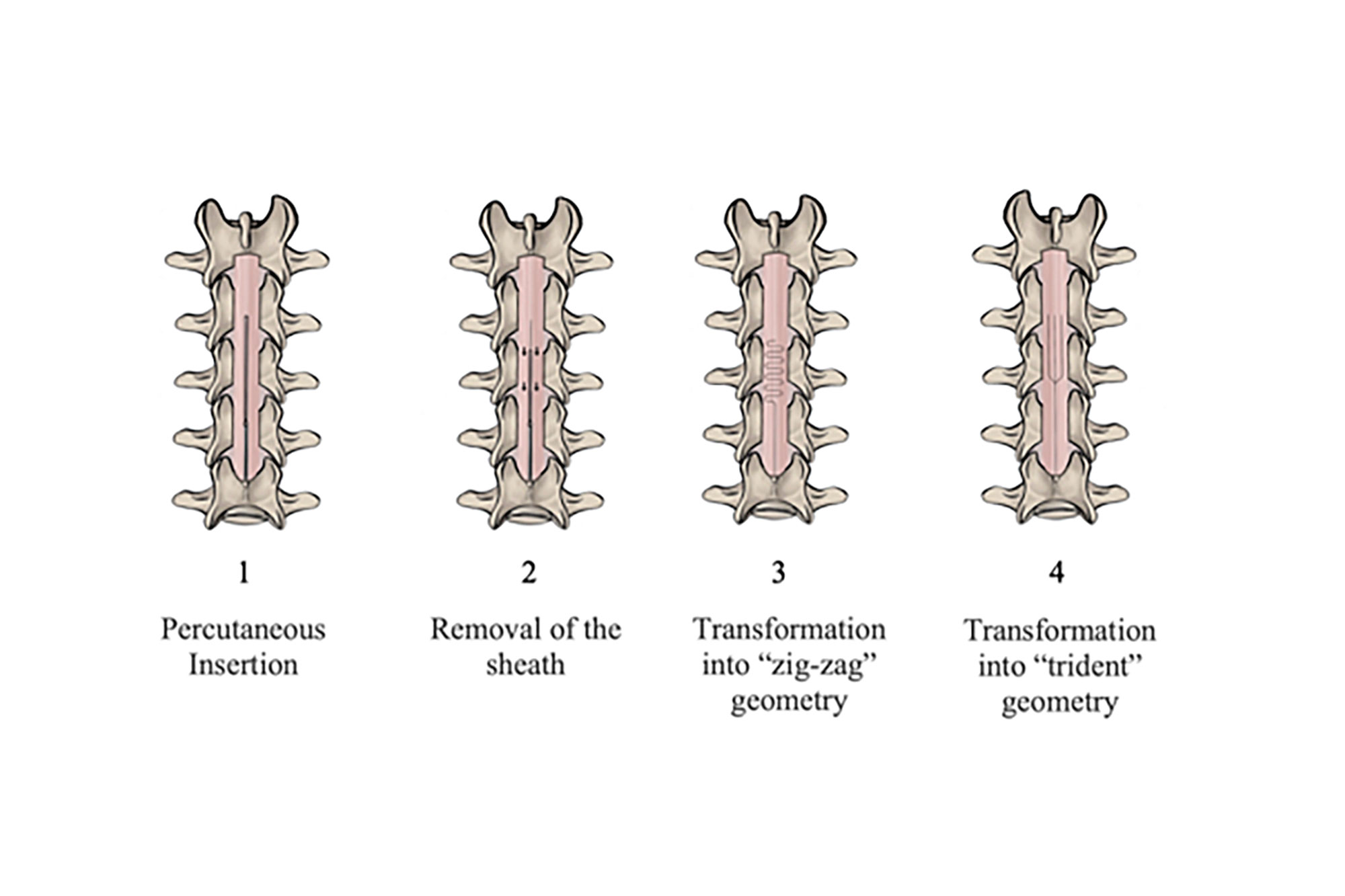 In steps 1 and 2, a percutaneous insertion into the epidural space takes place. In steps 3 and 4, the shape memory alloy lead reverts to new shapes that optimize electrode coverage.