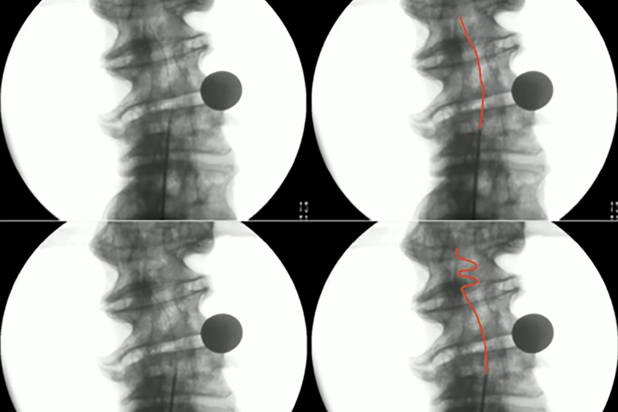 Fluoroscopic images from the cadaver trial (lead is highlighted in red in the images on the right). The images on the top show percutaneous minimally invasive lead insertion through a 2 mm- diameter hole. The images at the bottom show the shape memory alloy-based lead taking a desired zig-zag shape in the epidural space under body temperature actuation.