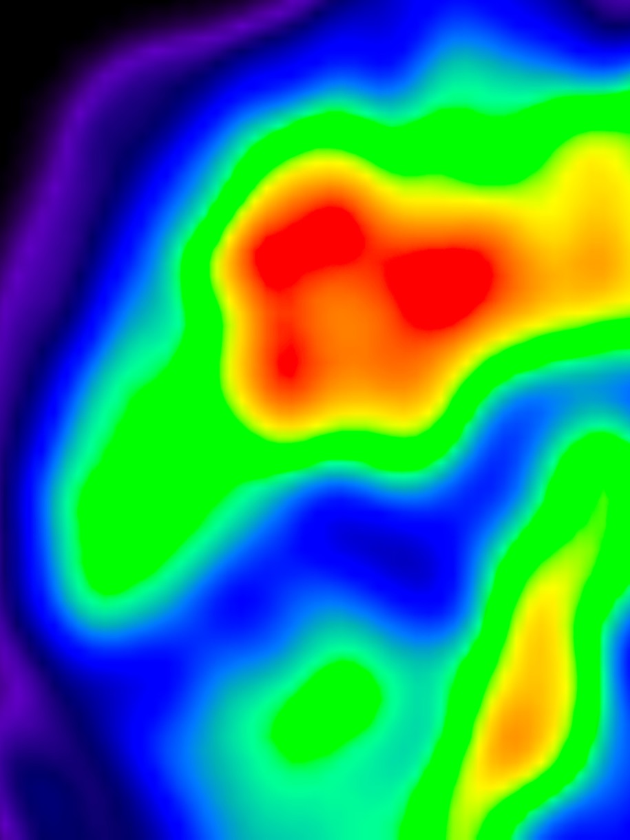 Images from florbetapir F18 PET scans of the posterior and medial sides of the brains of cognitively normal older adults, showing a high level of beta-amyloid plaque accumulation (in red and orange).